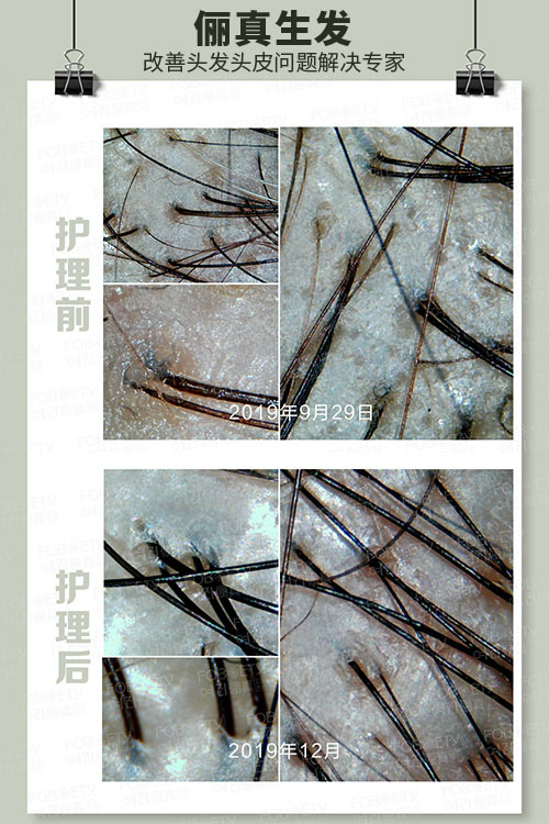 頭油、頭癢