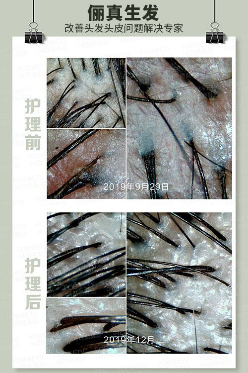 頭油、頭癢